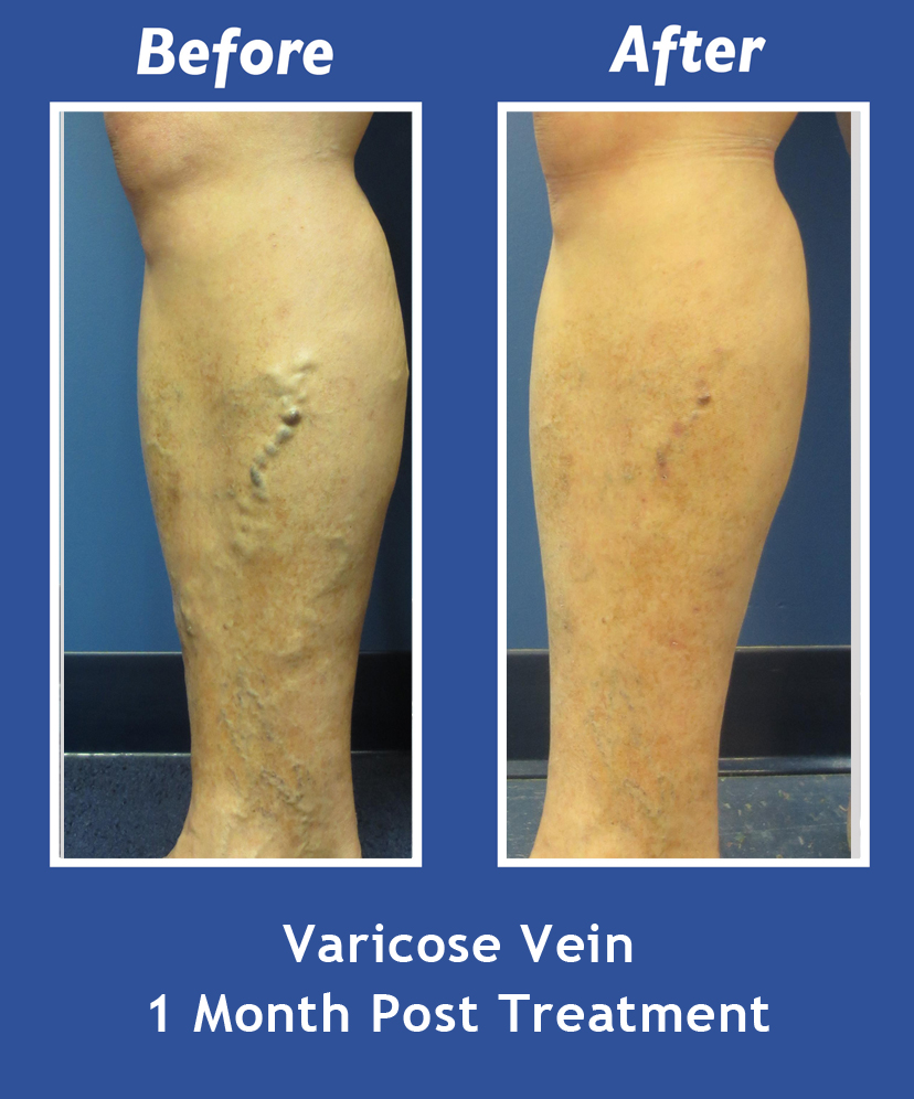 Before and After Leg Vein Treatment by Dr. Normand Miller, Salem, NH and Nashua, NH