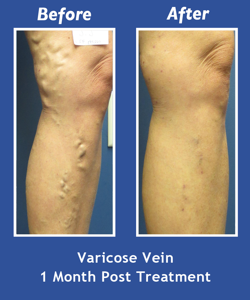 Before and After Leg Vein Treatment by Dr. Normand Miller, Salem, NH and Nashua, NH