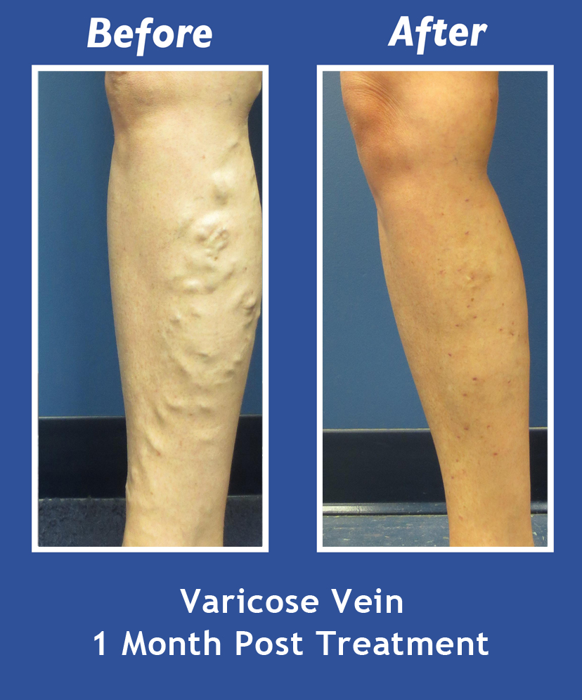 Before and After Leg Vein Treatment by Dr. Normand Miller, Salem, NH and Nashua, NH