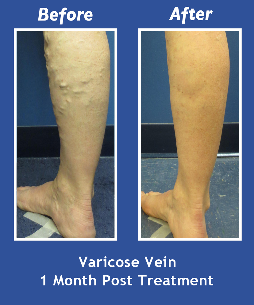 Before and After Leg Vein Treatment by Dr. Normand Miller, Salem, NH and Nashua, NH