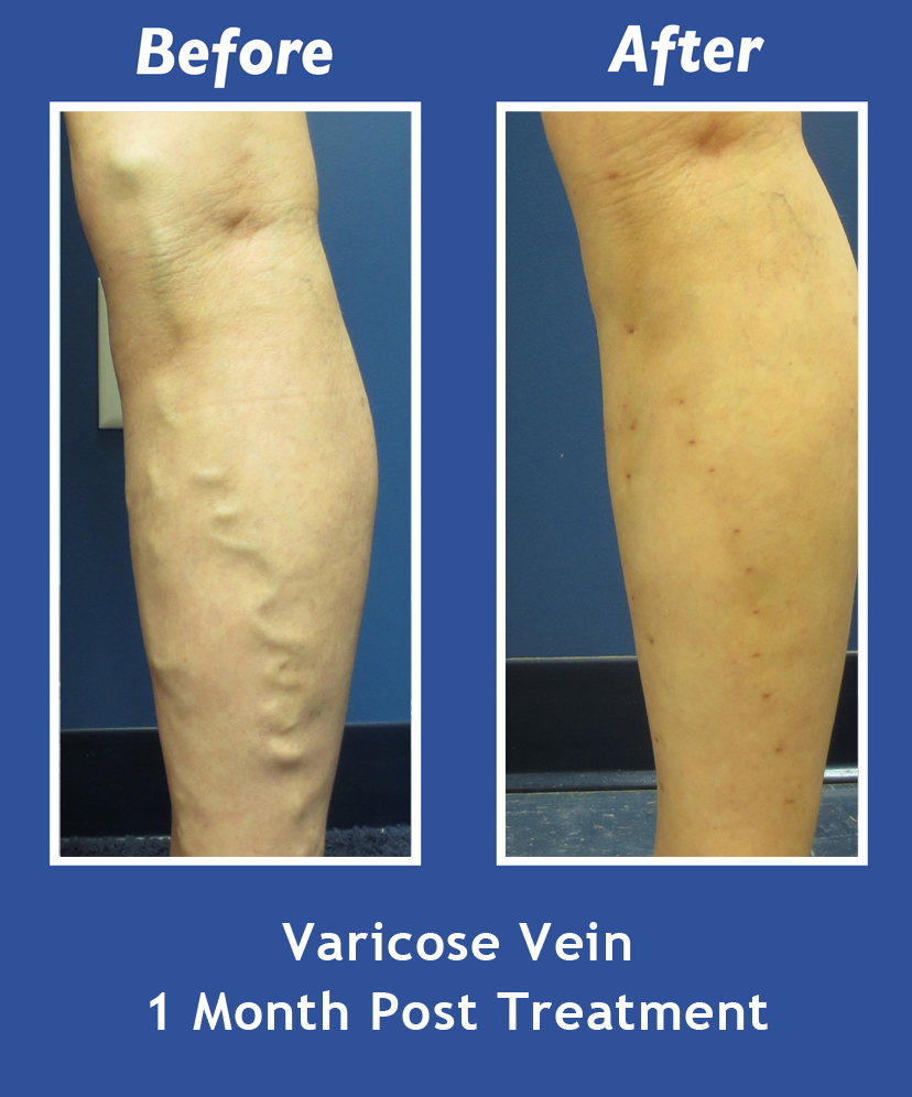 Before and After Leg Vein Treatment by Dr. Normand Miller, Salem, NH and Nashua, NH