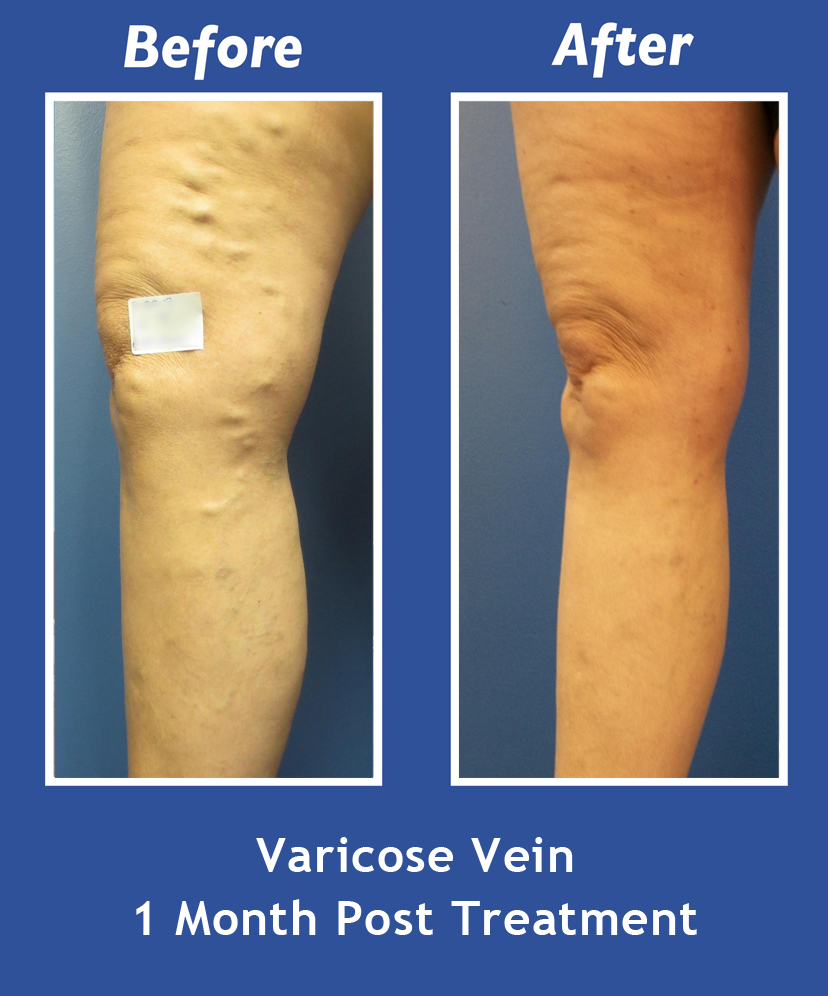 Before and After Leg Vein Treatment by Dr. Normand Miller, Salem, NH and Nashua, NH