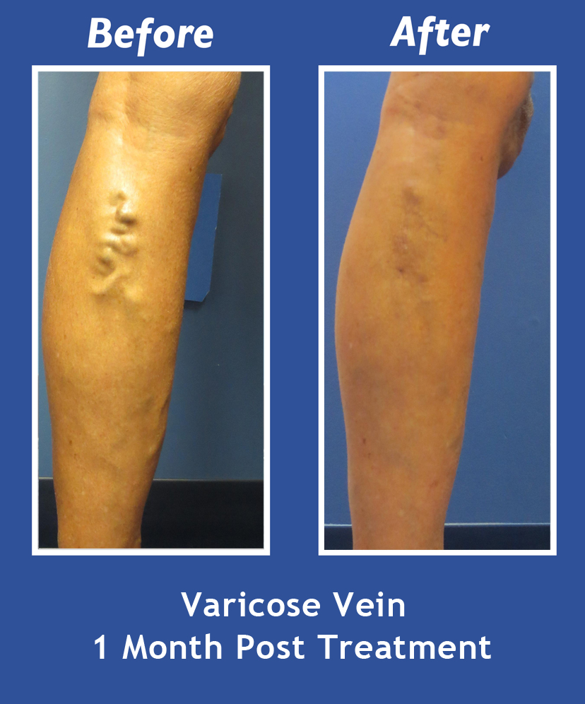 Before and After Leg Vein Treatment by Dr. Normand Miller, Salem, NH and Nashua, NH