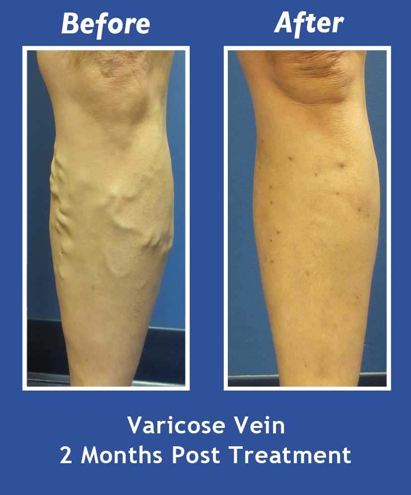 Before and After Leg Vein Treatment by Dr. Normand Miller, Salem, NH and Nashua, NH