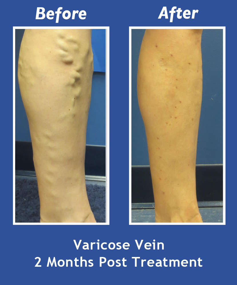 Before and After Leg Vein Treatment by Dr. Normand Miller, Salem, NH and Nashua, NH