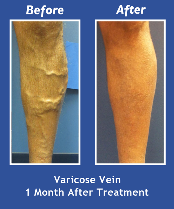 Before and After Leg Vein Treatment by Dr. Normand Miller, Salem, NH and Nashua, NH