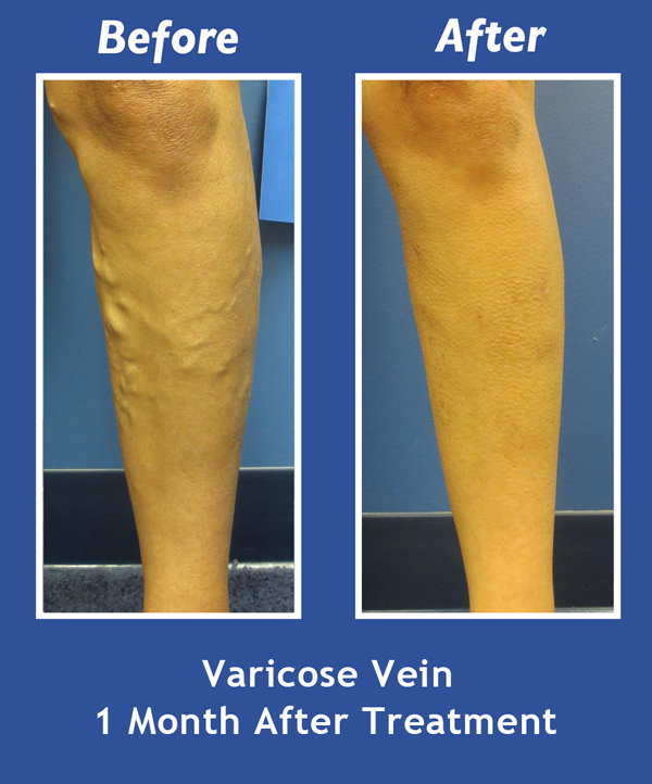 Before and After Leg Vein Treatment by Dr. Normand Miller, Salem, NH and Nashua, NH