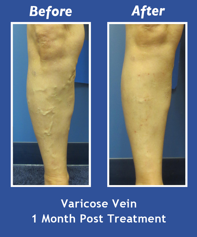 Before and After Leg Vein Treatment by Dr. Normand Miller, Salem, NH and Nashua, NH