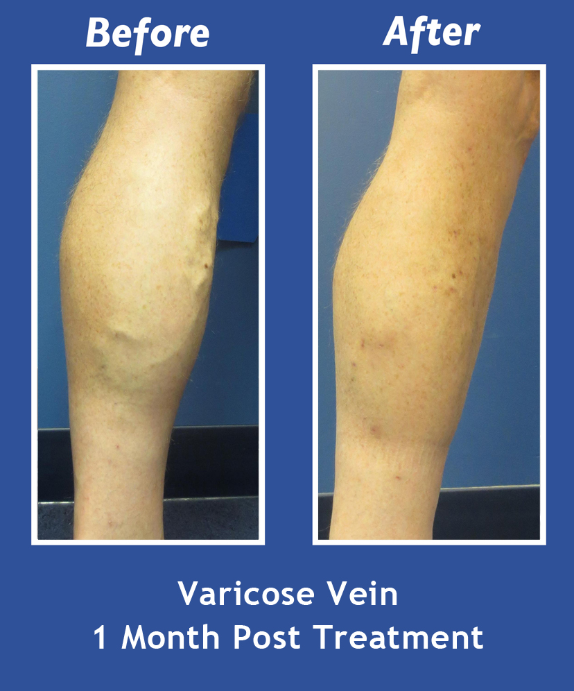 Before and After Leg Vein Treatment by Dr. Normand Miller, Salem, NH and Nashua, NH