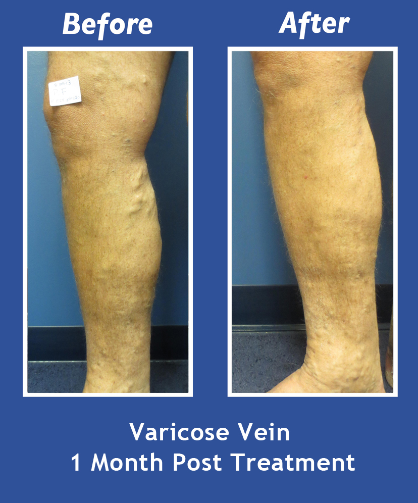 Before and After Leg Vein Treatment by Dr. Normand Miller, Salem, NH and Nashua, NH