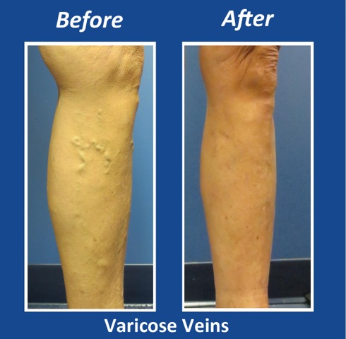 Before and After Leg Vein Treatment by Dr. Normand Miller, Salem, NH and Nashua, NH