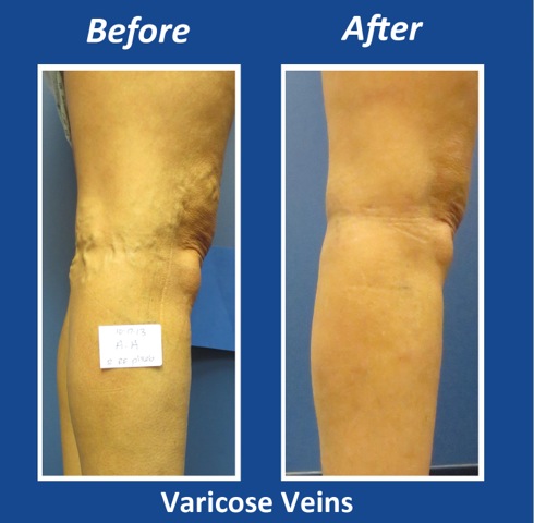 Before and After Leg Vein Treatment by Dr. Normand Miller, Salem, NH and Nashua, NH