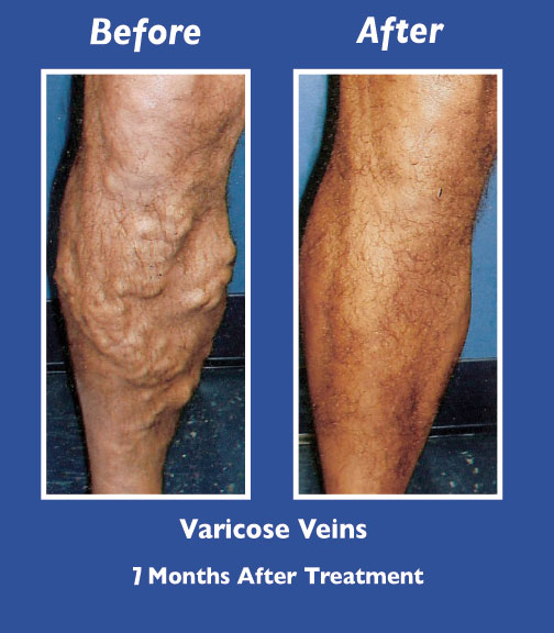 Before and After Leg Vein Treatment by Dr. Normand Miller, Salem, NH and Nashua, NH