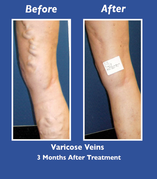 Before and After Leg Vein Treatment by Dr. Normand Miller, Salem, NH and Nashua, NH