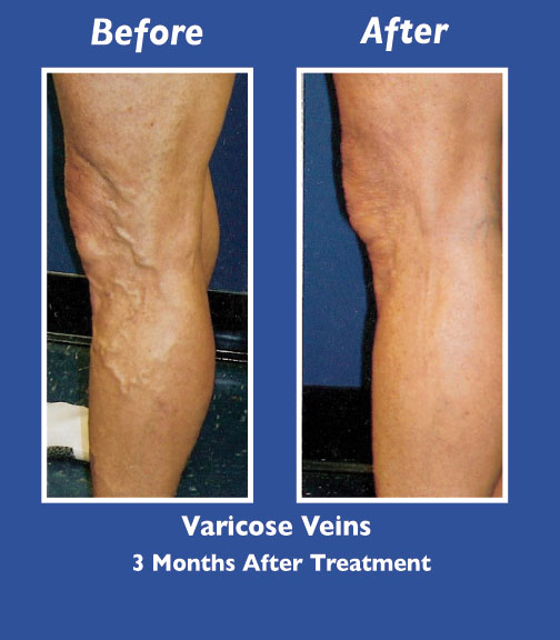 Before and After Leg Vein Treatment by Dr. Normand Miller, Salem, NH and Nashua, NH