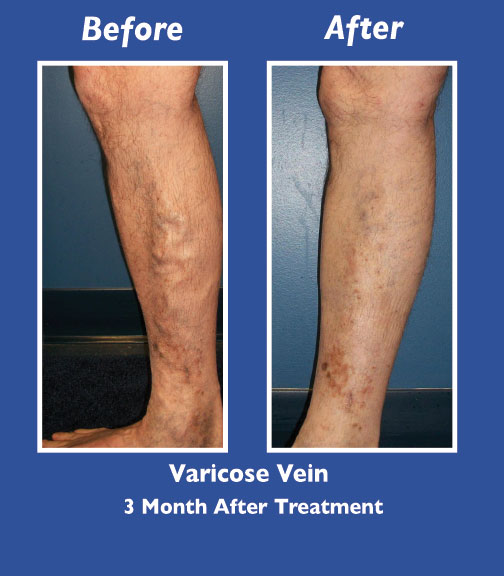 Before and After Leg Vein Treatment by Dr. Normand Miller, Salem, NH and Nashua, NH