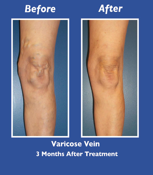 Before and After Leg Vein Treatment by Dr. Normand Miller, Salem, NH and Nashua, NH