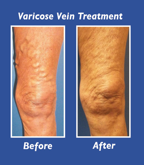 Before and After Leg Vein Treatment by Dr. Normand Miller, Salem, NH and Nashua, NH