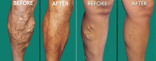 Before and After Leg Vein Treatment by Dr. Normand Miller, Salem, NH and Nashua, NH