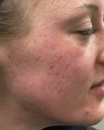 Before PCA Skin® Peel by Dr. Normand Miller, Salem, NH and Nashua, NH