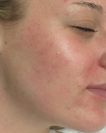 After PCA Skin® Peel by Dr. Normand Miller, Salem, NH and Nashua, NH