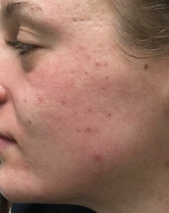 Before PCA Skin® Peel by Dr. Normand Miller, Salem, NH and Nashua, NH