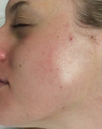 After PCA Skin® Peel by Dr. Normand Miller, Salem, NH and Nashua, NH
