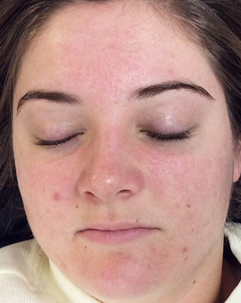 After PCA Skin® Peel by Dr. Normand Miller, Salem, NH and Nashua, NH