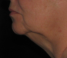 Before Precision Tx® Neck Lift by Dr. Normand Miller, Salem, NH and Nashua, NH