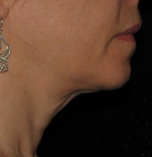After Precision Tx® Neck Lift by Dr. Normand Miller, Salem, NH and Nashua, NH