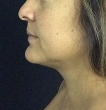 After Precision Tx® Neck Lift by Dr. Normand Miller, Salem, NH and Nashua, NH