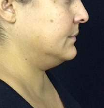 Before Precision Tx® Neck Lift by Dr. Normand Miller, Salem, NH and Nashua, NH