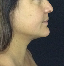 After Precision Tx® Neck Lift by Dr. Normand Miller, Salem, NH and Nashua, NH