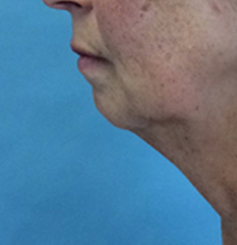 Before Precision Tx® Neck Lift by Dr. Normand Miller, Salem, NH and Nashua, NH