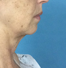 After Precision Tx® Neck Lift by Dr. Normand Miller, Salem, NH and Nashua, NH