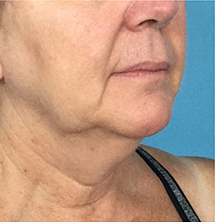 Before Precision Tx® Neck Lift by Dr. Normand Miller, Salem, NH and Nashua, NH