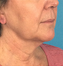 After Precision Tx® Neck Lift by Dr. Normand Miller, Salem, NH and Nashua, NH