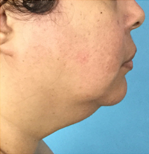 Before Precision Tx® Neck Lift by Dr. Normand Miller, Salem, NH and Nashua, NH