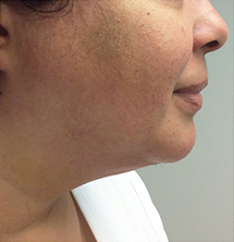 After Precision Tx® Neck Lift by Dr. Normand Miller, Salem, NH and Nashua, NH