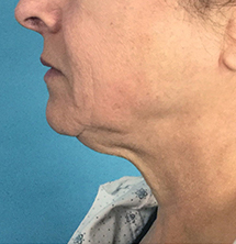 Before Precision Tx® Neck Lift by Dr. Normand Miller, Salem, NH and Nashua, NH