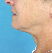 After Precision Tx® Neck Lift by Dr. Normand Miller, Salem, NH and Nashua, NH