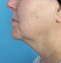 Before Precision Tx® Neck Lift by Dr. Normand Miller, Salem, NH and Nashua, NH