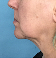 After Precision Tx® Neck Lift by Dr. Normand Miller, Salem, NH and Nashua, NH