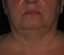 Before Skin Tightening by Dr. Normand Miller, Salem, NH and Nashua, NH