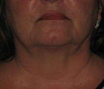 After Skin Tightening by Dr. Normand Miller, Salem, NH and Nashua, NH