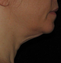 Before Skin Tightening by Dr. Normand Miller, Salem, NH and Nashua, NH