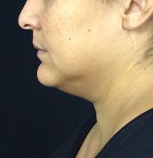 Before Skin Tightening by Dr. Normand Miller, Salem, NH and Nashua, NH