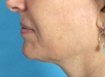 After Skin Tightening by Dr. Normand Miller, Salem, NH and Nashua, NH