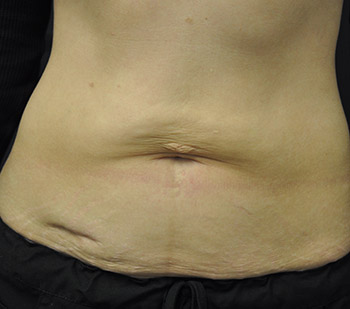 Before Skin Tightening by Dr. Normand Miller, Salem, NH and Nashua, NH