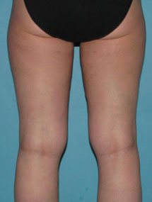 After SmartLipo™ by Dr. Normand Miller, Salem, NH and Nashua, NH